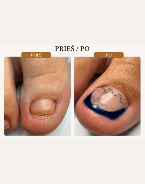 Arkada Sin Brace - Lengvos kojos